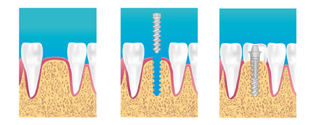 pose_implant p